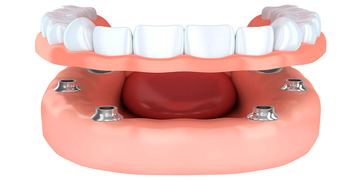 Dental implant illustration